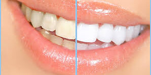 before/after whitening cosmetic