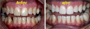 whitening
